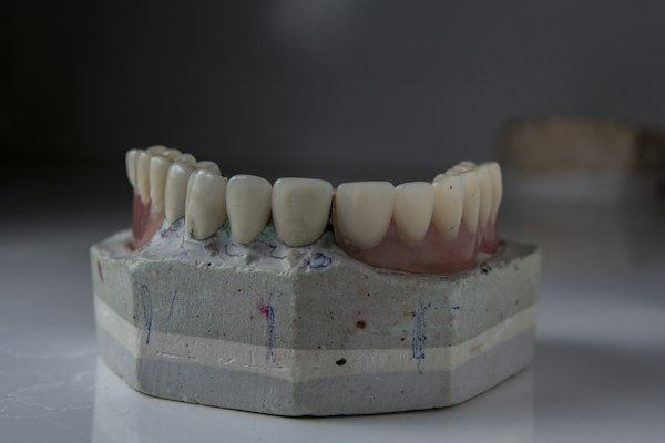 3-Unit PFM Bridge