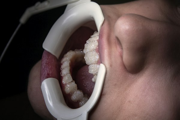 Re-Root Canal Treatment