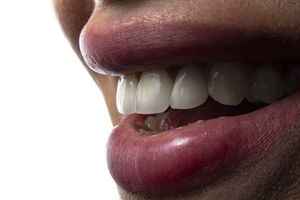 Zirconia Crown